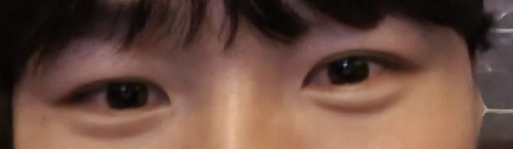  남자 부분절개 쌍수 후기 2달차 (광고X, 내돈내쌍, 속쌍, 눈매교정,가성안검하수)