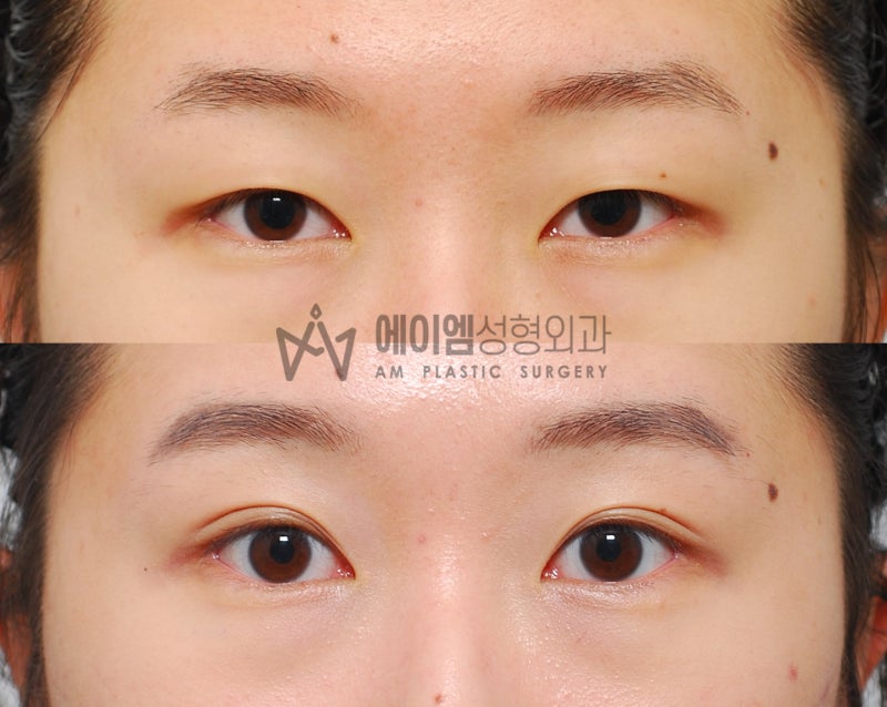 쌍꺼풀 수술 가격