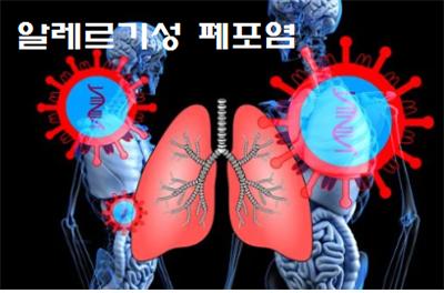  알레르기성 폐포염 폐에 염증 유발