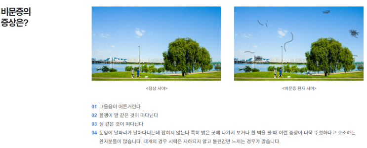 비문증에 걸리다