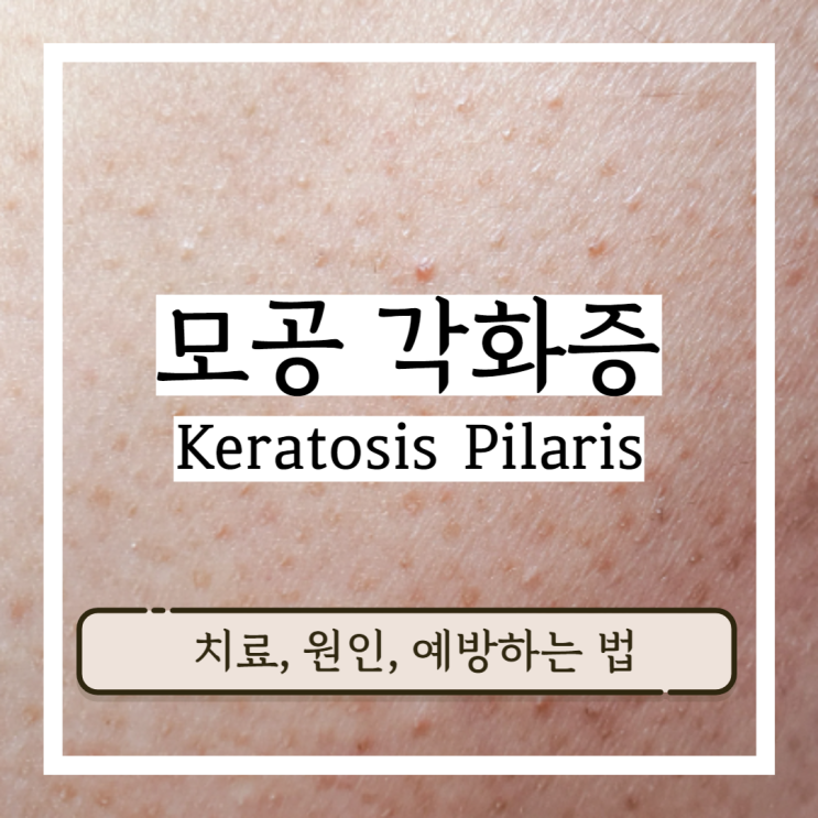 모공 각화증 치료 원인 및 예방법 모공 각화증 치료 원인 및 예방법