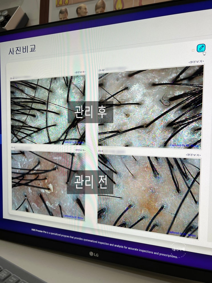  [천호 탈모] 닥터모락 천호점 두피스케일링 복합성 민감성 두피 케어 후기