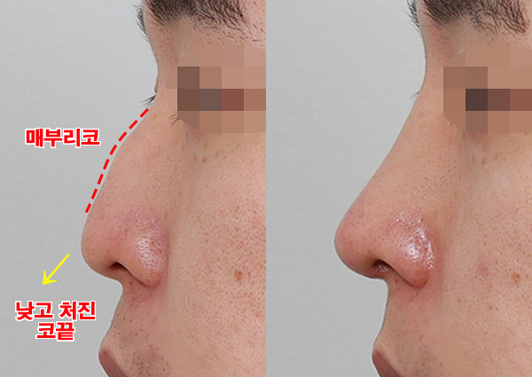  남자코수술, 만족도 높은 직선코!(강남성형외과 치유 후기)