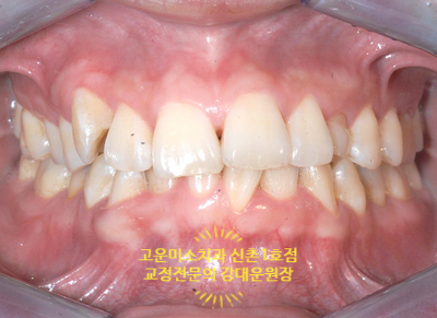 송곳니결손(견치결손) 매복치 과개교합 2급부정교합 블랙트라이앵글 비발치 치료증례 신촌교정치과 교정전문의 강대운원장 고운미소신촌1호점 치료증례