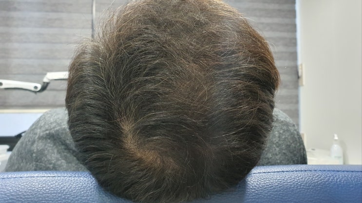  대구남성탈모 모발 재생의 비밀을 밝혀라: 효과적인 탈모 치료 전략