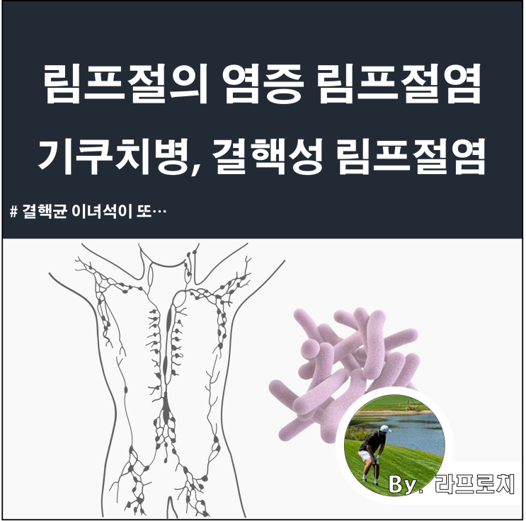  림프절염(임파선염)과 기쿠치병 증상 및 치료법