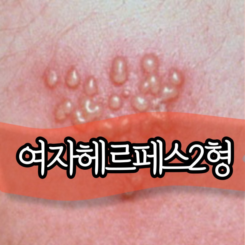 여자 헤르페스 2형 증상 완치 전염 바이러스 검사 방법까지 알려드려요