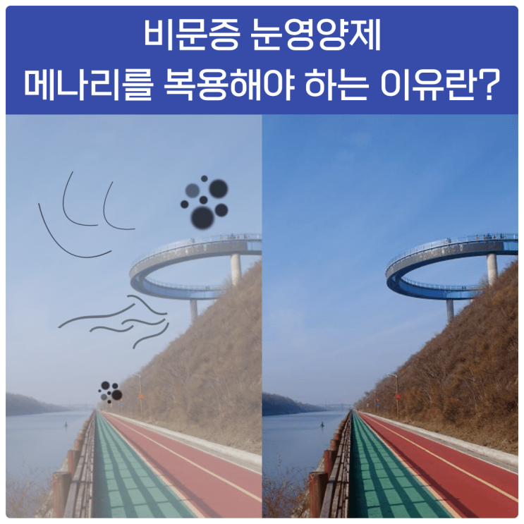  비문증 영양제 메나리를 복용해야 하는 이유란?