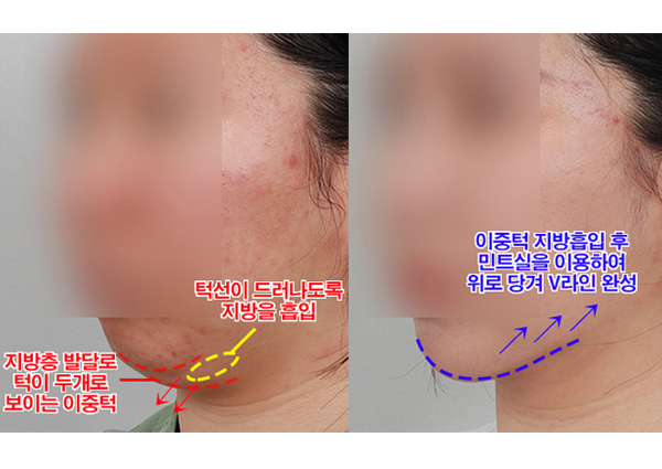  (얼굴지방흡입) 이중턱이 고민이었어요!ㅠㅠ강남역성형외과
