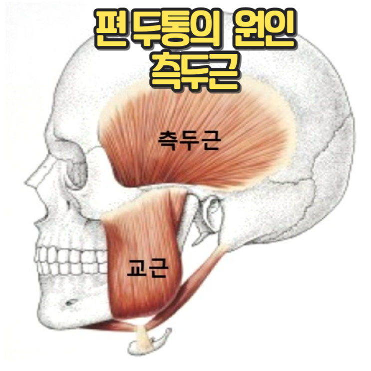 편두통의 원인 측두근(Temporalis muscle)의 발통점 및 방사통 & 측두근 마사지