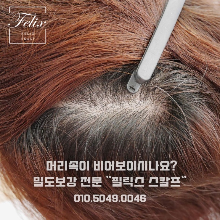 탈모 스트레스 한번에 날려보세요~탈모커버 잘하는곳 필릭스 스칼프라면 GOOD!!(김포 간석 제물포 역삼 군산)