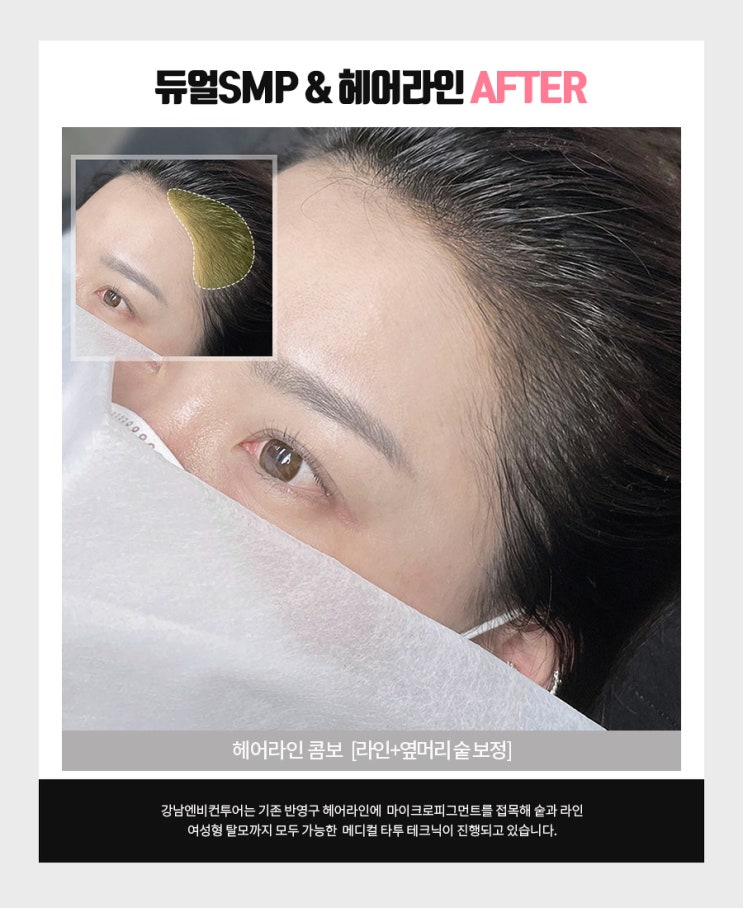  헤어라인문신 병원 합리적인 비용으로 시술받자