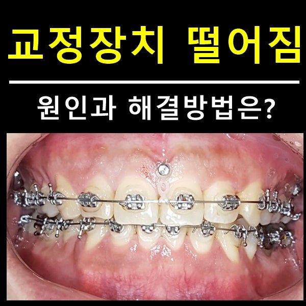 교정장치 떨어짐, 유지장치 떨어졌을때 원인과 대처방법 : 네이버 블로그 교정장치 떨어짐, 유지장치 떨어졌을때 원인과 대처방법 : 네이버 블로그