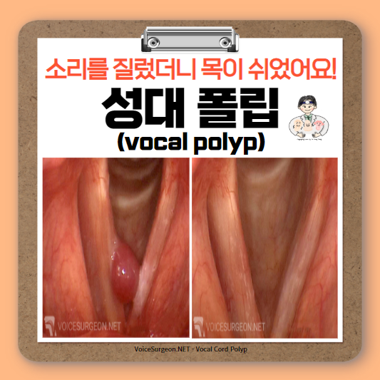  쉰 목소리 (2) - 성대폴립(vocal polyp)