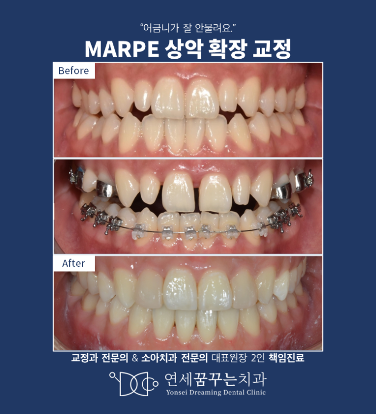 좁은 위턱과 왜소치(작은 앞니, 기형치)를 갖는 성인에서 MARPE 치료, 치위생사분 치료