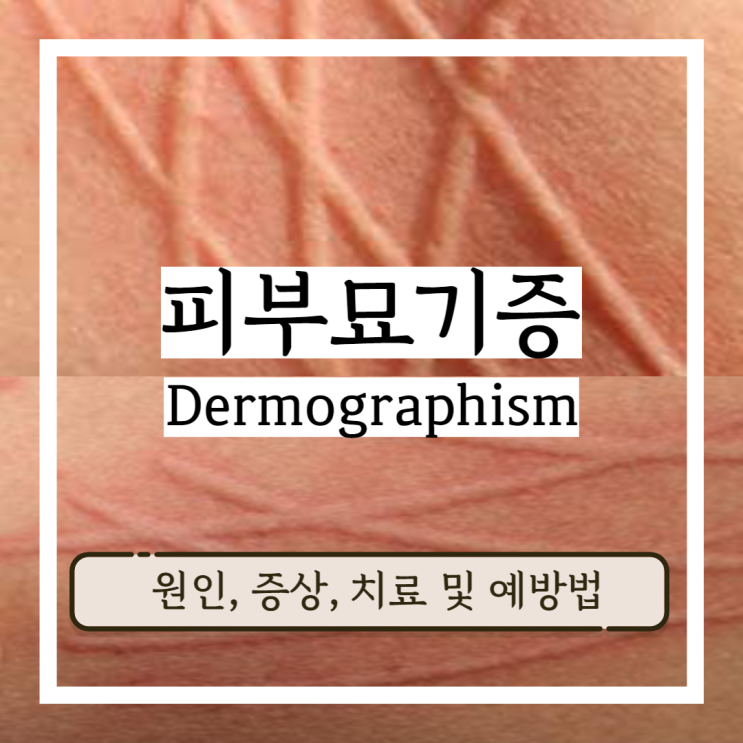 피부 묘기증 긁으면두드러기 올라오는 피부 묘기증 증상 원인 치료 및 예방법 피부 묘기증 긁으면두드러기 올라오는 피부 묘기증 증상 원인 치료 및 예방법