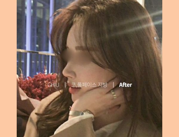  풀페이스 지방이식, 유지 기간 궁금해요?(신사동성형외과 치유)