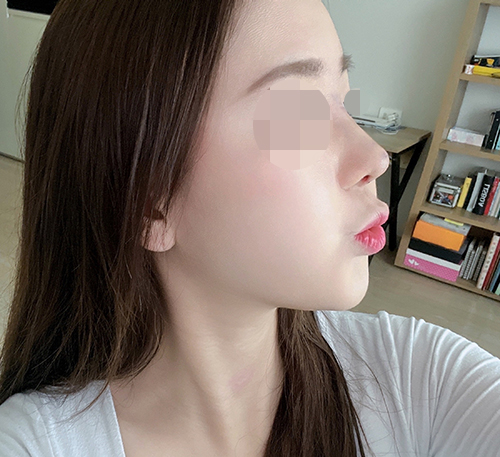  뭉툭하고 퍼진 코끝 / 복코교정으로 개선 <강남복코수술후기>