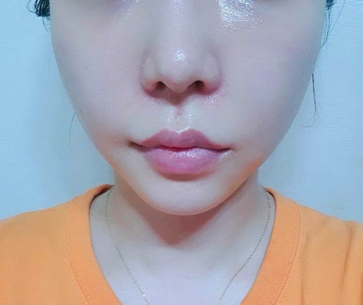  내돈내산 교대역 코조각주사&광대축소주사 후기