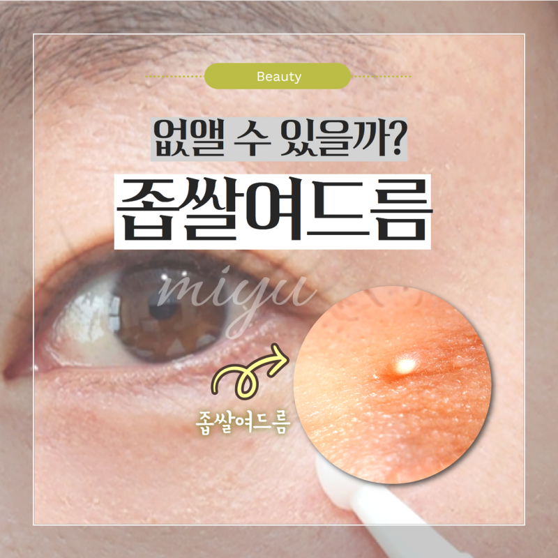 좁쌀여드름 없애기 얼굴 화장품 낫츠 연고 특급레시피 : 네이버 블로그 좁쌀여드름 없애기 얼굴 화장품 낫츠 연고 특급레시피 : 네이버 블로그
