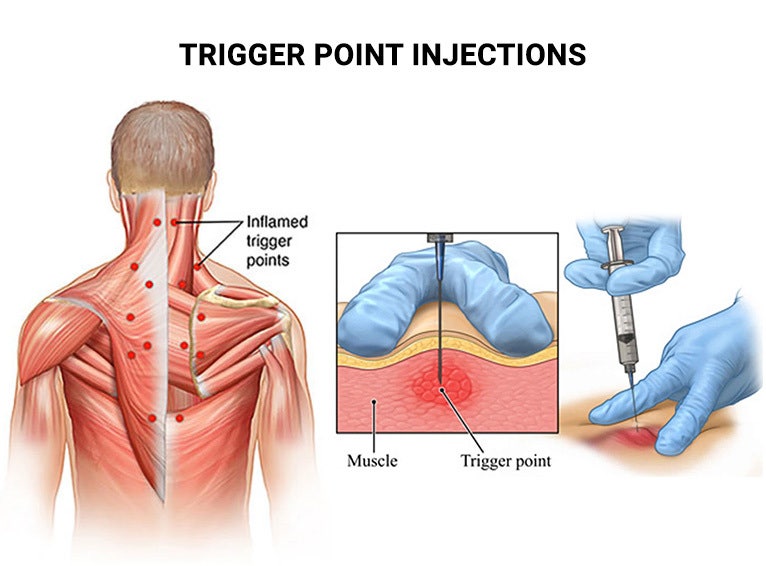 tpi-trigger-point-injection