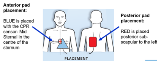 Temporary Pacemaker(TPM), 임시심박동기 : 네이버 블로그