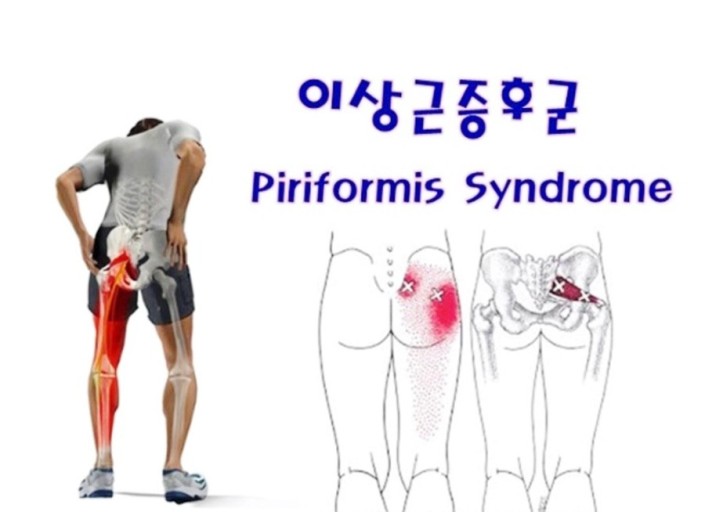 이상근(Piriformis. m)  단축검사 및 통증 해결 방법