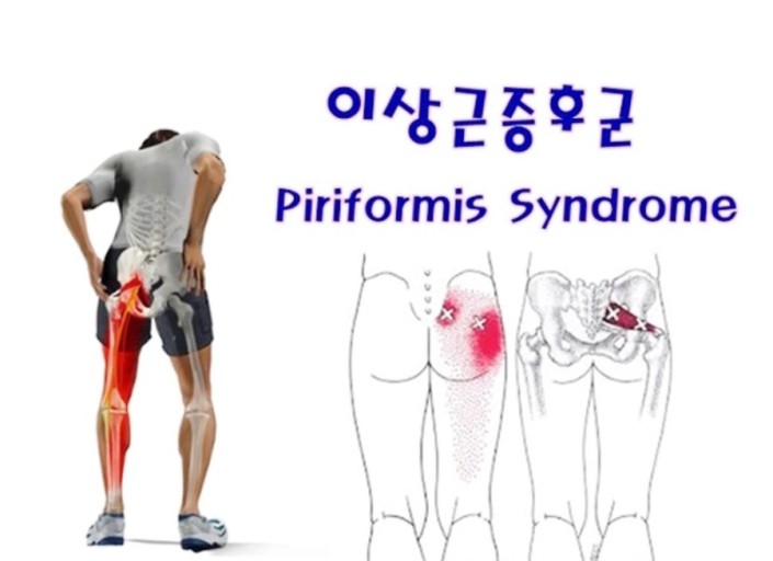  이상근(Piriformis. m)  단축검사 및 통증 해결 방법