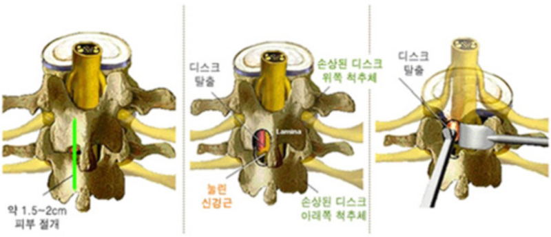 현미경 추간판제거술 : 네이버 블로그