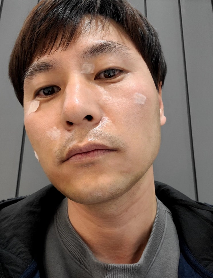  남자 수염제모 아포지플러스 레이져제모 1회 스타트!, 제모가격, 제모기간 등 수염제모 솔직후기(내돈내산)