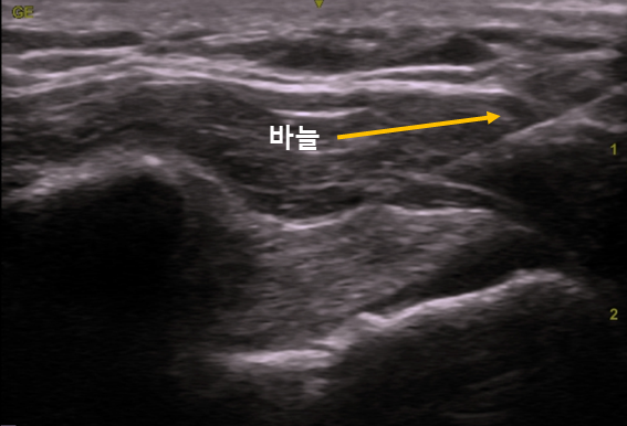  광주어깨병원, 오십견 통증 알고 방문하세요