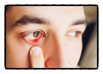 눈 다래끼의 원인, 예방 및 치료방법