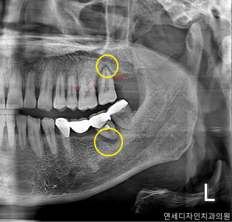 신길동 임플란트 염증 무시하면 어떻게 될까 6