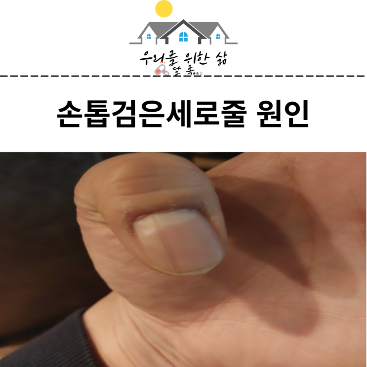  손톱검은세로줄 생기는 이유 흑색종 관리법 알아보기