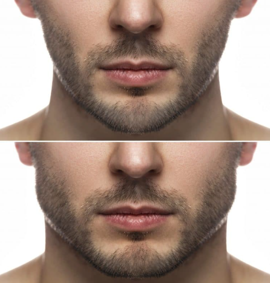 남자 사각턱 턱보톡스 효과와 기간은 얼마나?