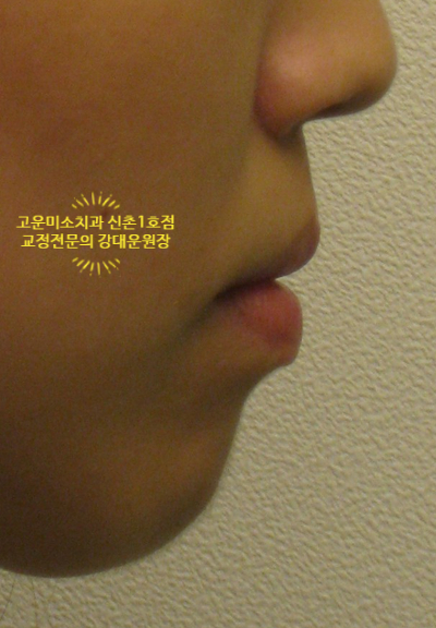  긴 얼굴 돌출입 2급부정교합 뚱한 입술  작은 어금니 하나결손으로 정중선이 안 맞는 교정치료증례 신촌치과  고운미소신촌1호점 교정전문의 강대운원장 증례