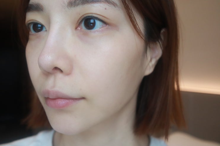  눈밑주름 없애는 법, 제오민 눈가보톡스 + 리쥬란아이 효과 좋네