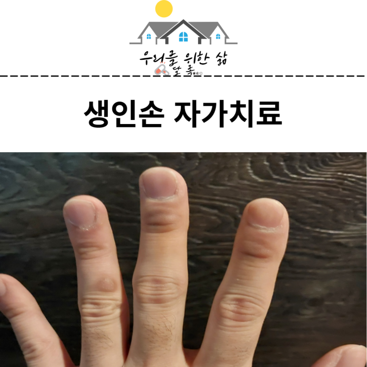  생인손 자가치료 방법 조갑주위염 알아보기