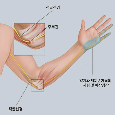  (스마트폰 중독)팔꿈치 통증 척골신경 마비 손상 원인 증상 치료법 예방법