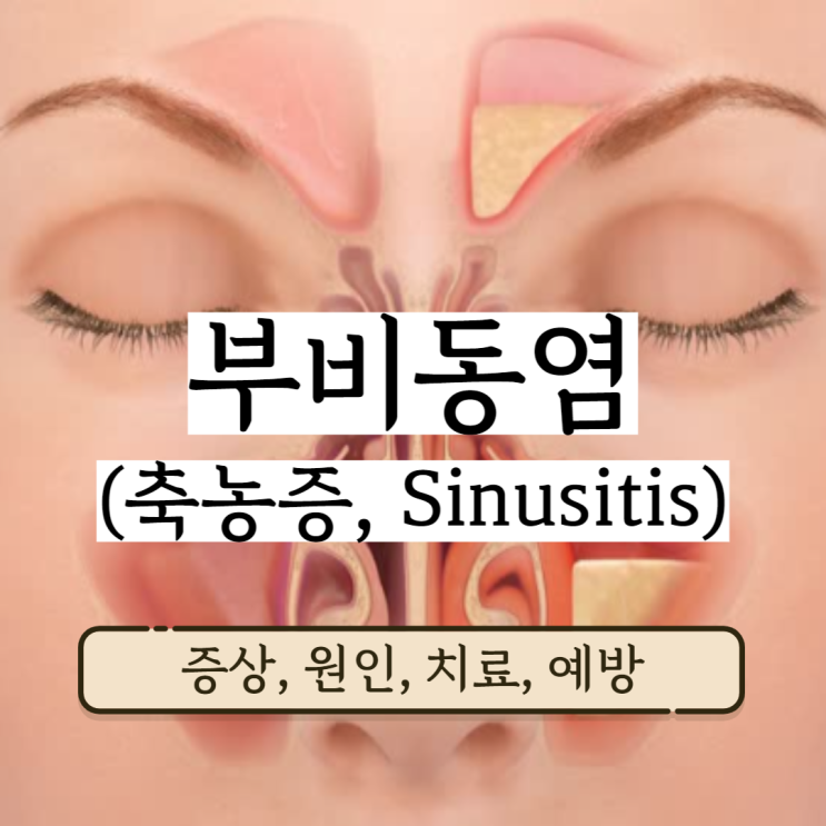 부비동염 축농증증상 축농증 원인 부비동염증상 치료 및 예방 (치통, 턱관절, 익돌근) 부비동염 축농증증상 축농증 원인 부비동염증상 치료 및 예방 (치통, 턱관절, 익돌근)