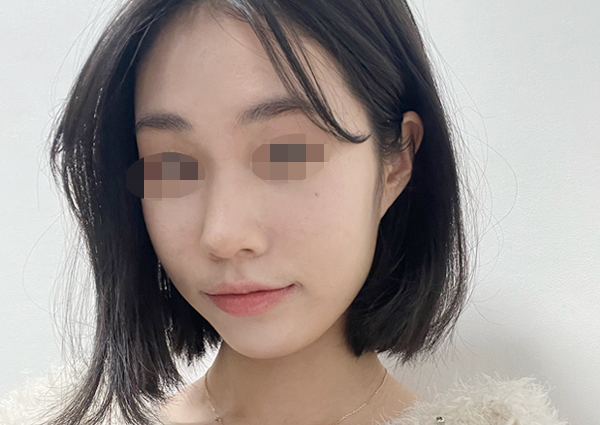  매부리코수술, 신뢰가 가는 곳에서!(자연스러운코수술후기)