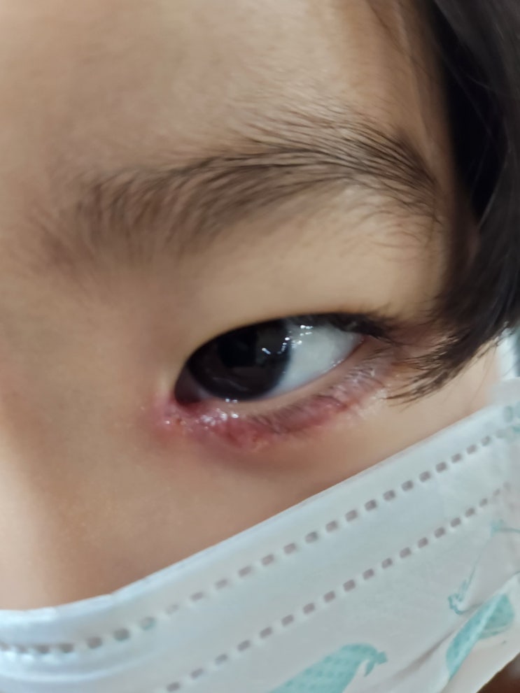  5살 아이 유아 안검내반 수술 후기  몽고주름 대비 어린이 앞트임 후기 더 커지고 이뻐진 눈매 변화