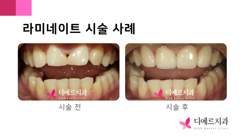 라미네이트 치료 전 치아 삭제 과정에 대해 알아볼까요?