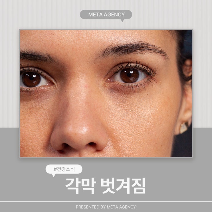  각막벗겨짐의 원인과 예방하는법 알려드려요