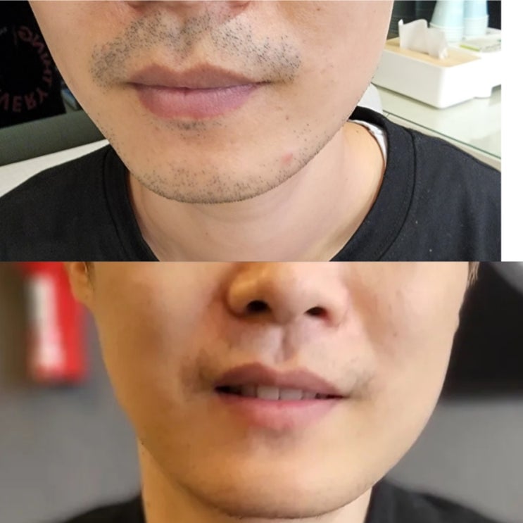  피부과 남자수염 레이저제모 주기 가격 인중 제모 턱 모낭염 없는 3회차 3주 후기 스플렌더X 추천