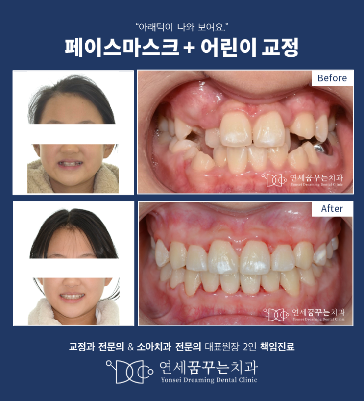 초등학교 고학년의 턱교정(페이스마스크) 치료에 관하여, 어린이 턱교정의 골든타임 초등학교 고학년의 턱교정(페이스마스크) 치료에 관하여, 어린이 턱교정의 골든타임