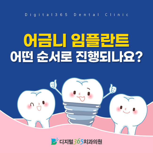  울산 삼산 임플란트치과, 어금니 임플란트 어떤 순서로 진행되나요?