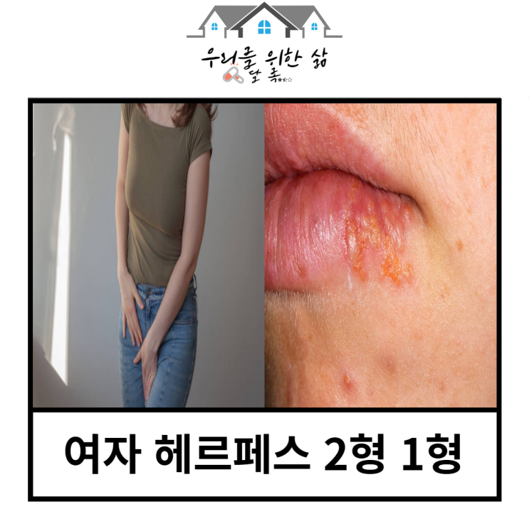 여자 헤르페스 2형 증상,원인 치료법 첫 감염 때를 놓치지 말자
