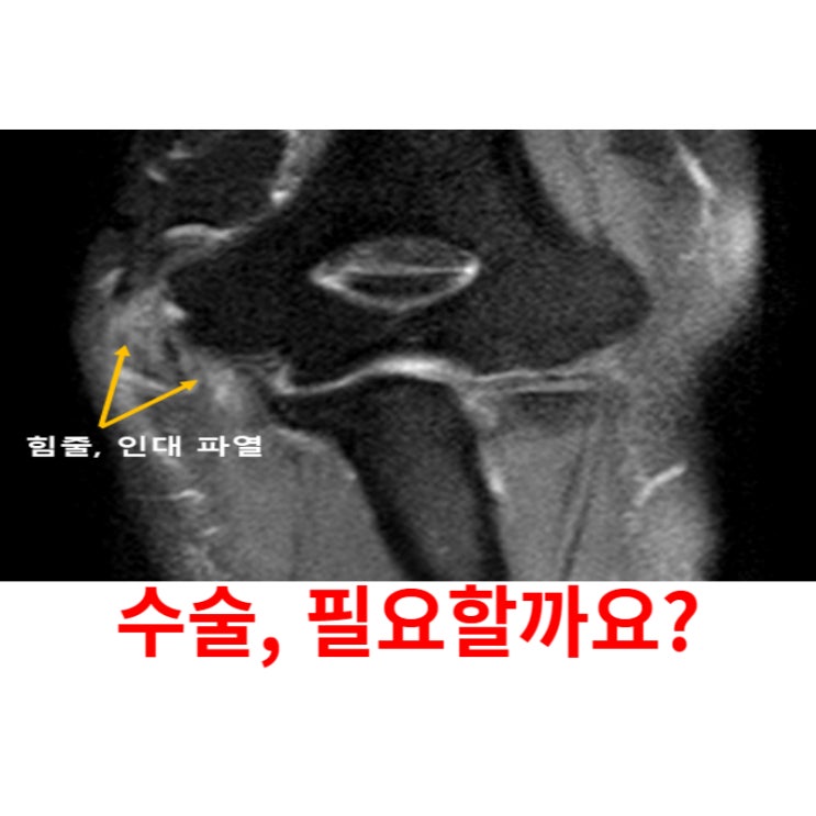  광주팔꿈치통증병원, 골프엘보 수술하지 마세요
