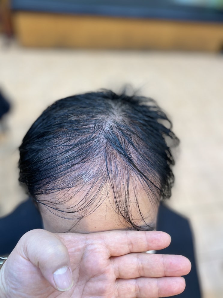  이식문신해도 휑하다 모내기하듯 꼼꼼히 남자탈모펌/사상구중구서구사하구진구영도구강서구금정구수영구남구해운대구북구